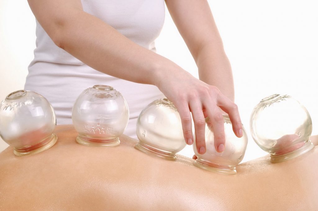 Cupping Therapy